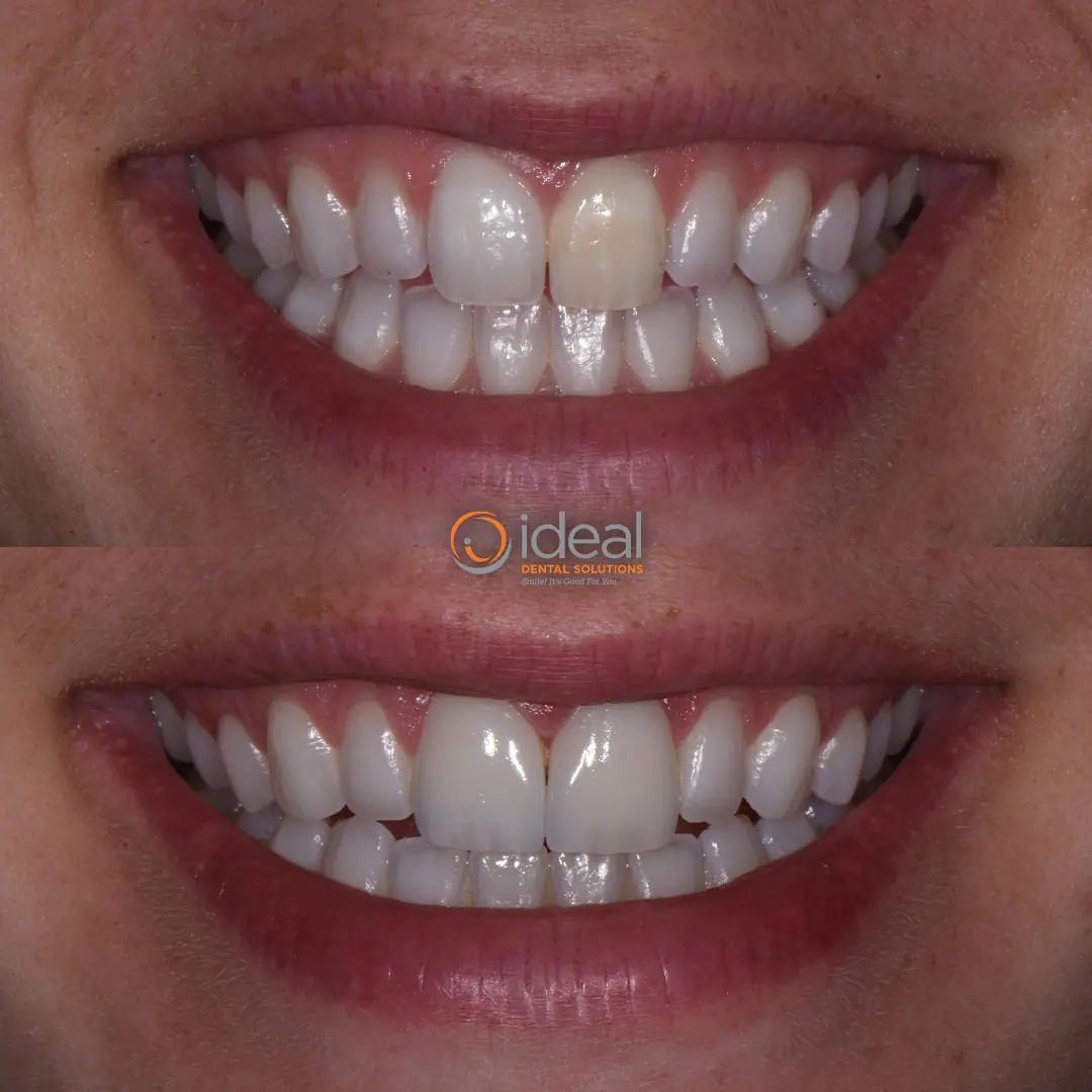 Before and after smile treatment at Ideal Dental Solutions, case 1