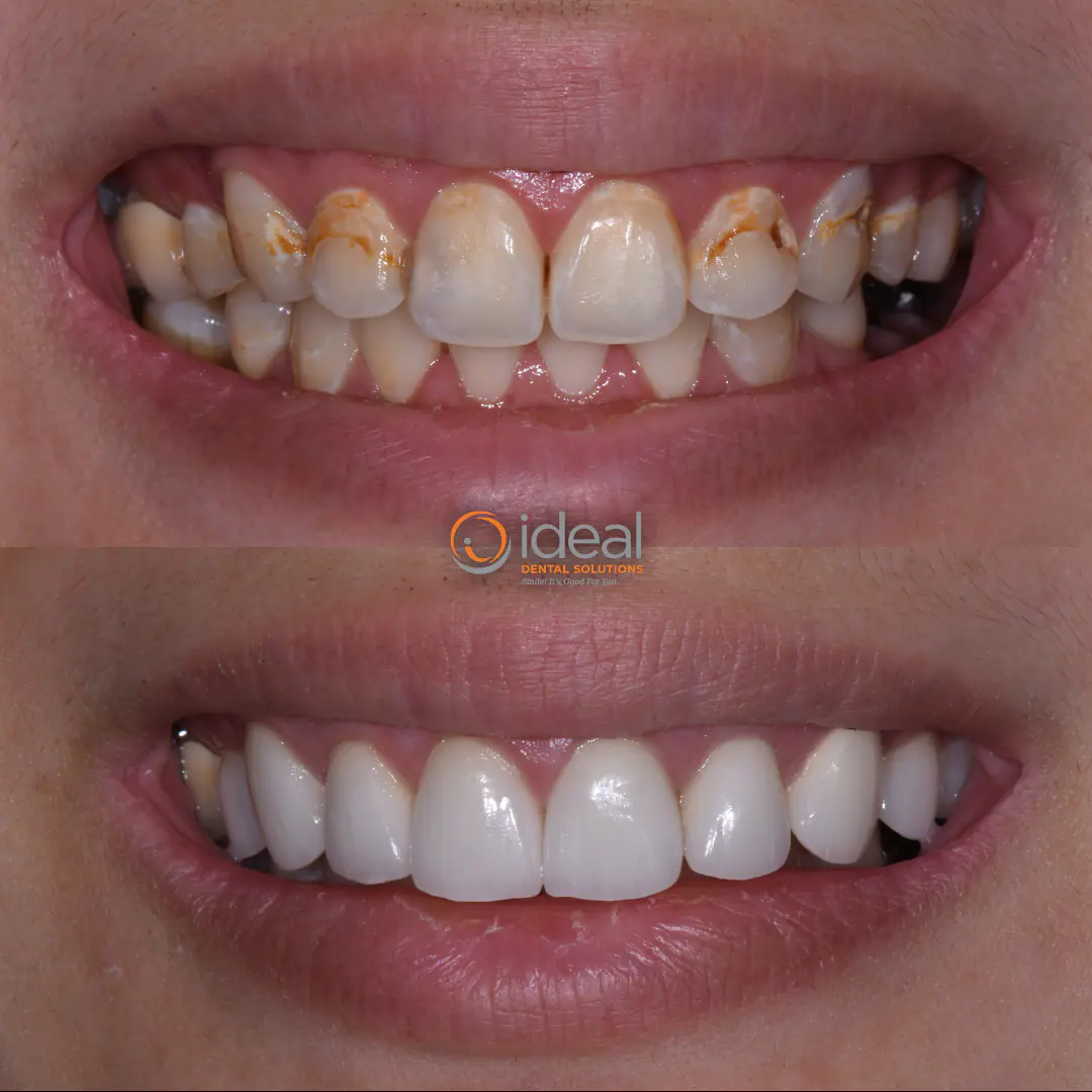 Before and after smile treatment at Ideal Dental Solutions, case 2