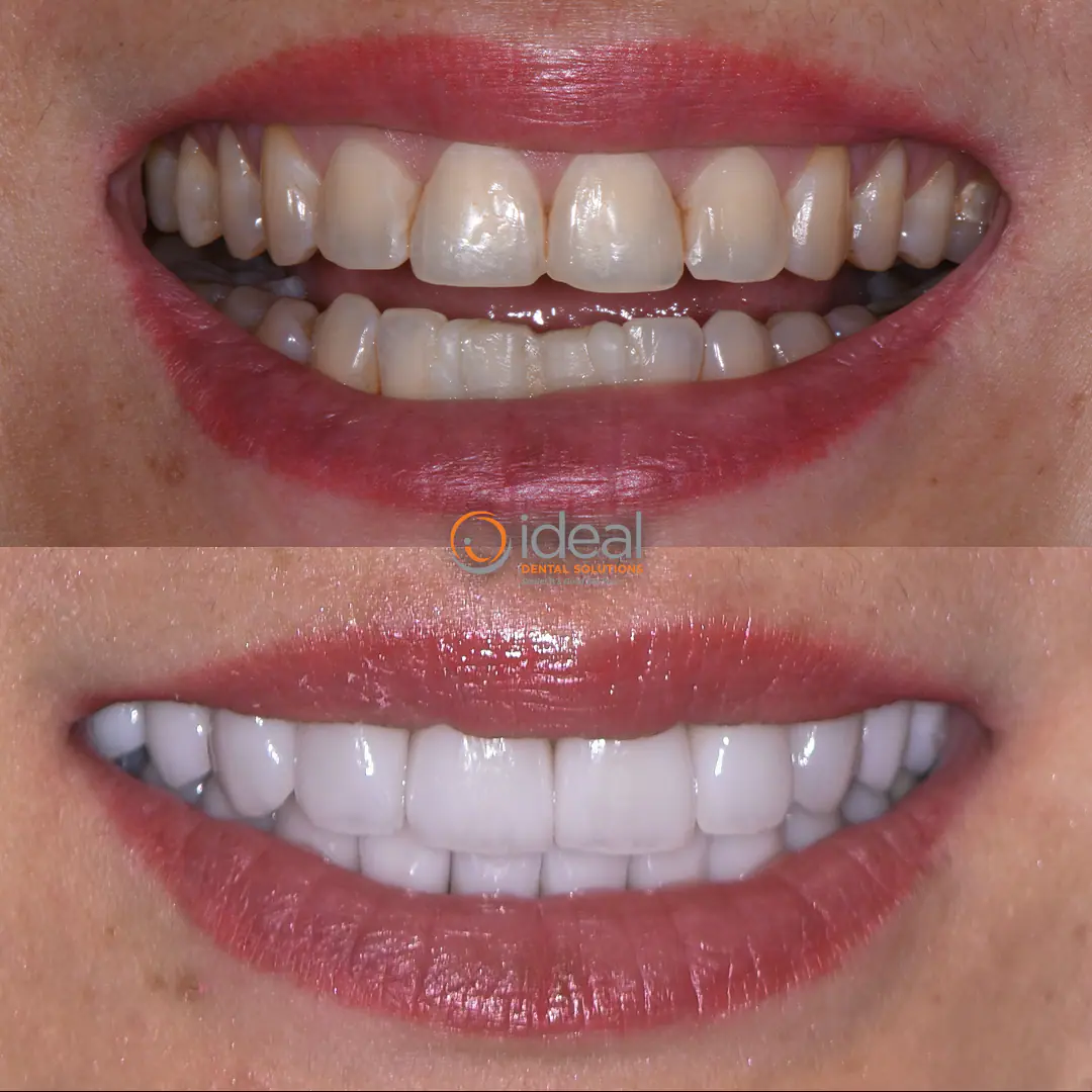 Before and after smile treatment at Ideal Dental Solutions, case 5