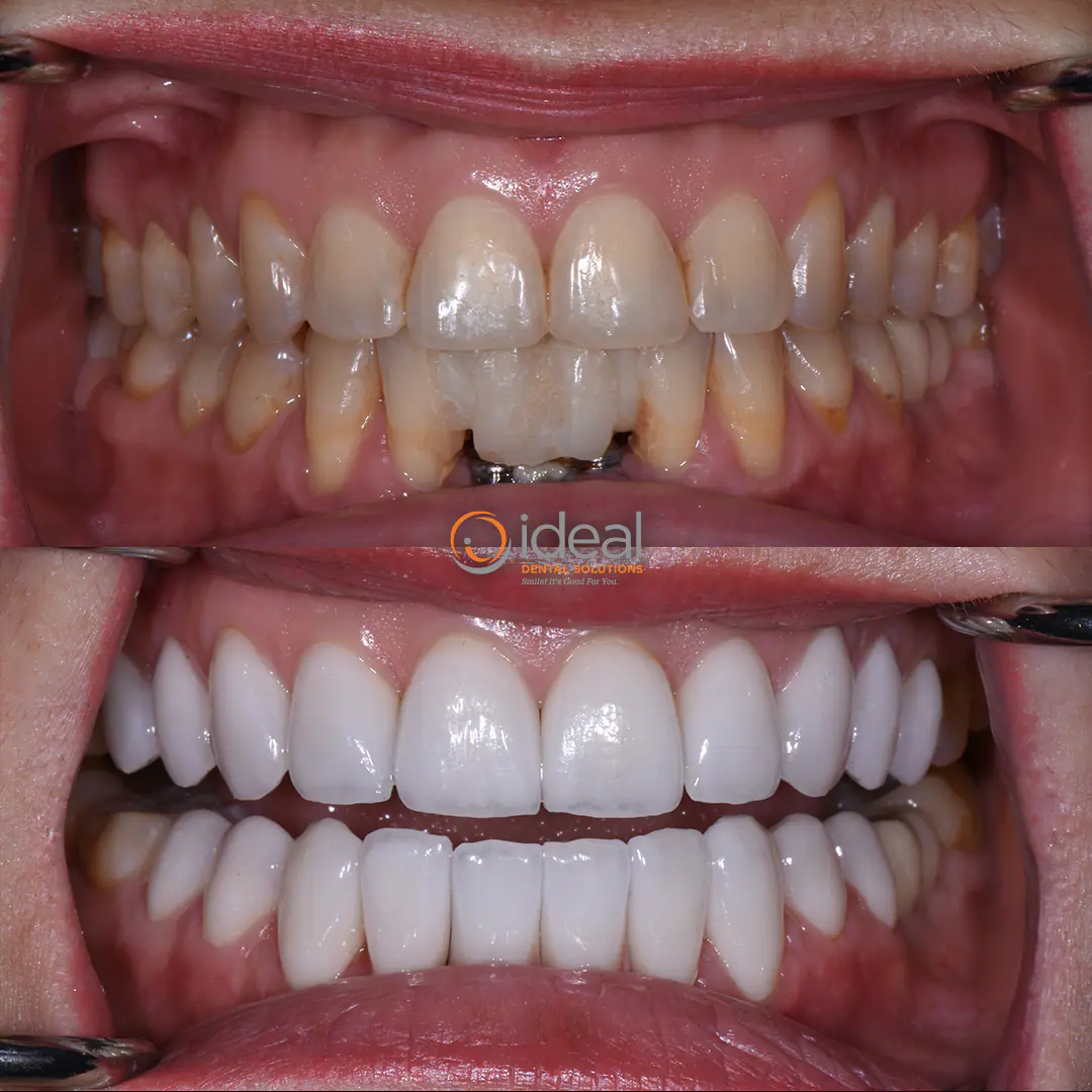 Before and after smile treatment at Ideal Dental Solutions, case 6