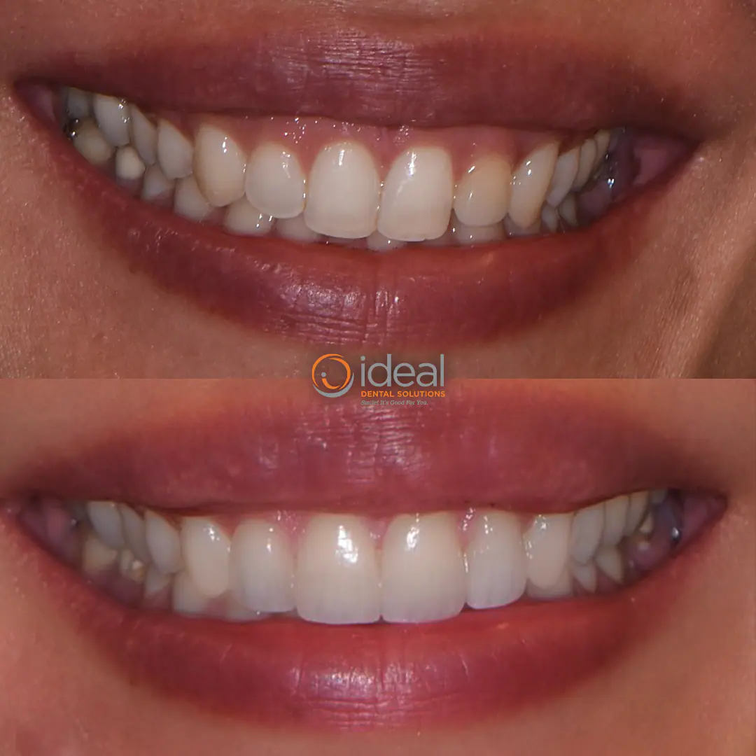 Before and after smile treatment at Ideal Dental Solutions, case 9