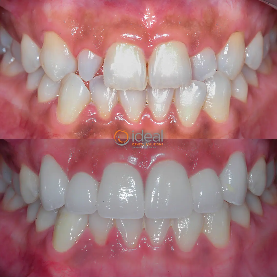 Before and after smile treatment at Ideal Dental Solutions, case 11