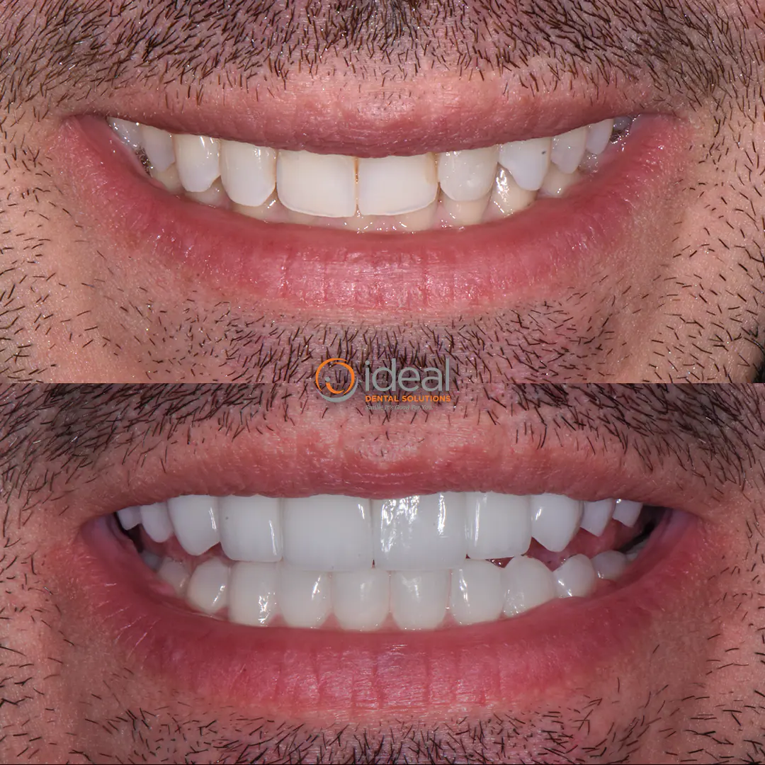 Before and after smile treatment at Ideal Dental Solutions, case 12