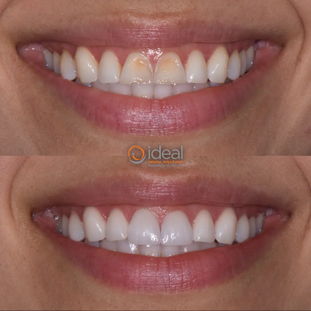 Before and after smile treatment at Ideal Dental Solutions, case 13