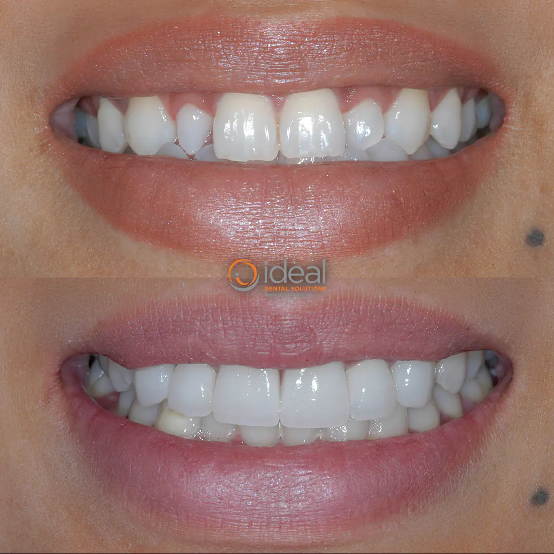 Before and after smile treatment at Ideal Dental Solutions, case 16