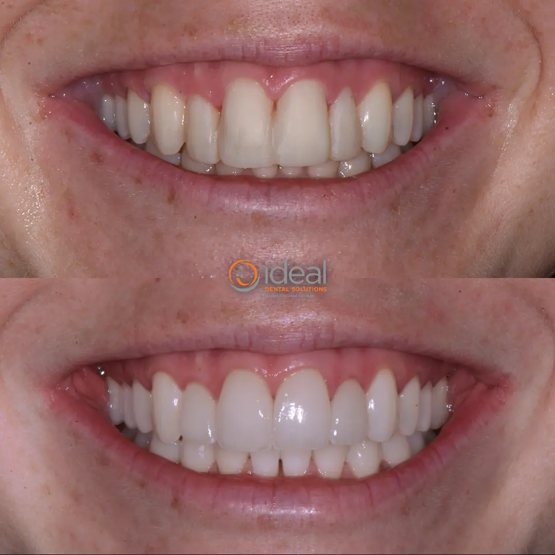 Before and after smile treatment at Ideal Dental Solutions, case 17