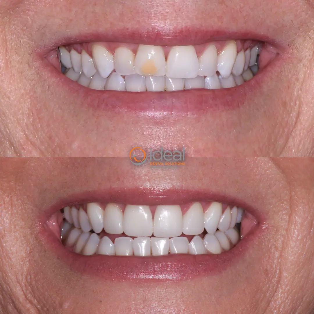Before and after smile treatment at Ideal Dental Solutions, case 21